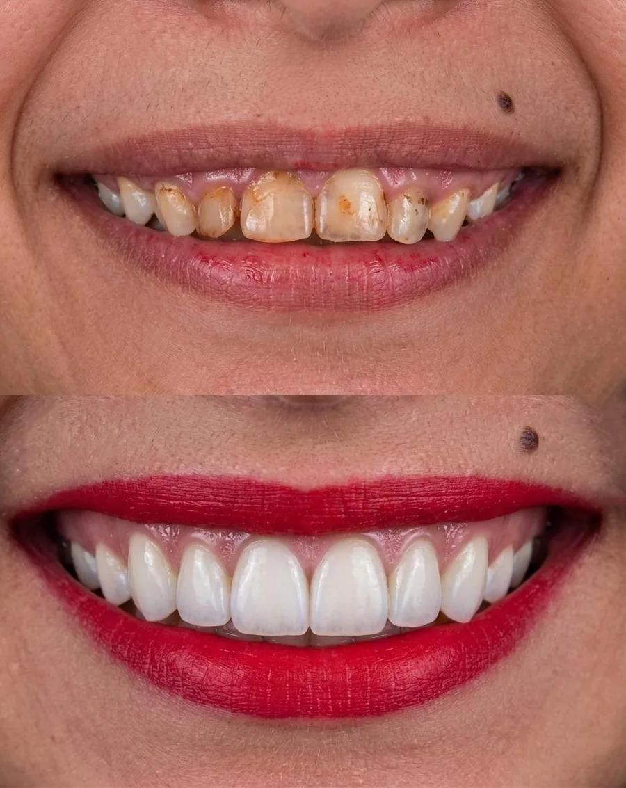 ابتسامة قبل وبعد ترميم الأسنان الأمامية وتجميلها